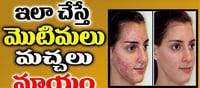 మొటిమలను మచ్చలను ఎలా పోగొట్టుకోవాలో తెలుసా..?